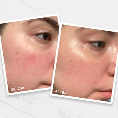 Our Top Tips to Treat Acne