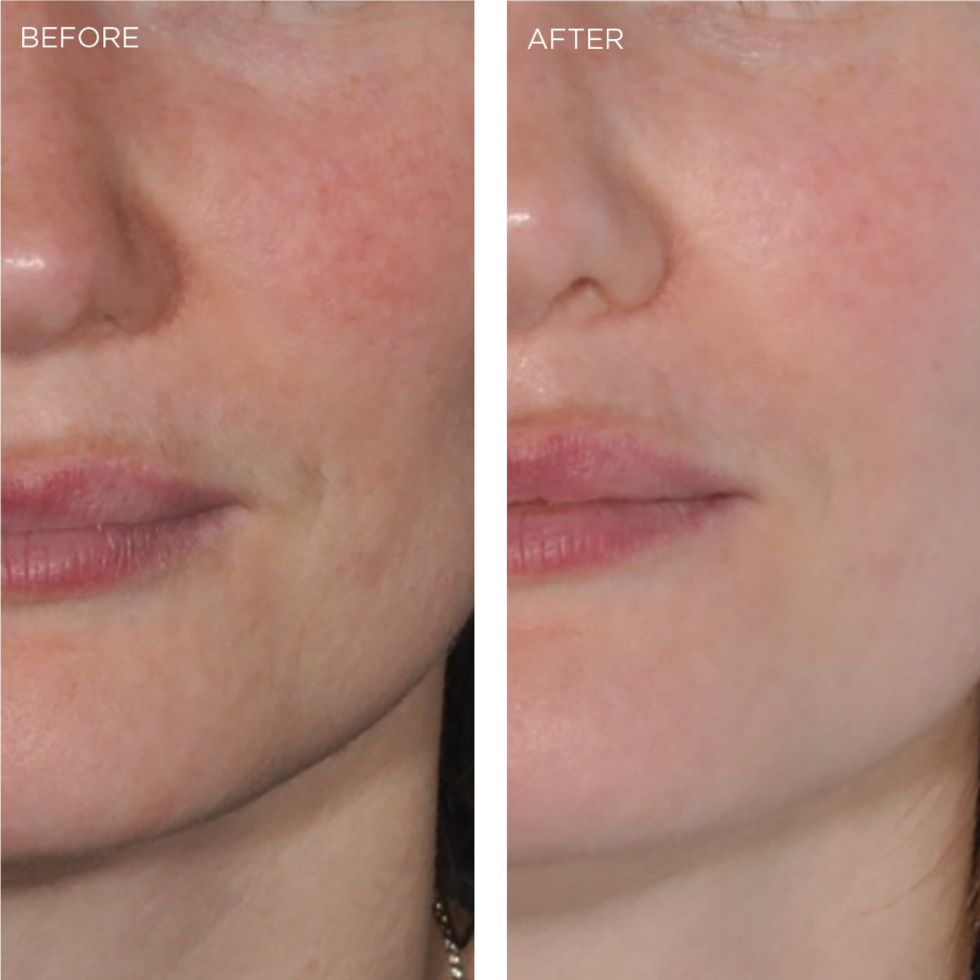 Before and After a Single Use of Our Brightening Peel